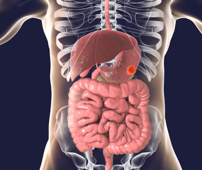 Causas do câncer de estômago Núcleo